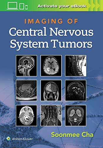 Imaging of Central Nervous System Tumors – PDF ebook