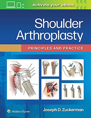 Shoulder Arthroplasty: Principles and Practice – PDF ebook