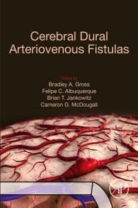Cerebral Dural Arteriovenous Fistulas – PDF ebook