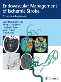 Endovascular Management of Ischemic Stroke: A Case-based Approach – PDF ebook