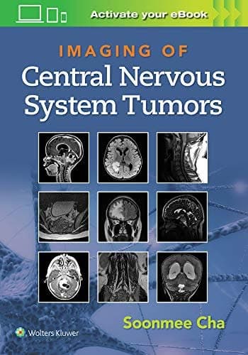 Imaging of Central Nervous System Tumors – PDF ebook