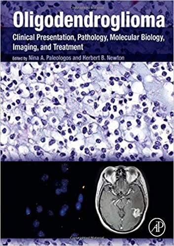 Oligodendroglioma: Clinical Presentation, Pathology, Molecular Biology, Imaging, and Treatment – PDF ebook