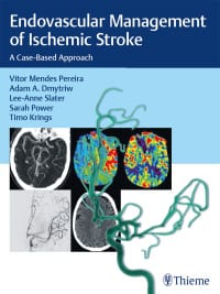 Endovascular Management of Ischemic Stroke: A Case-based Approach – PDF ebook