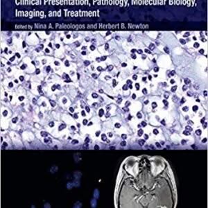 Oligodendroglioma: Clinical Presentation, Pathology, Molecular Biology, Imaging, and Treatment – PDF ebook